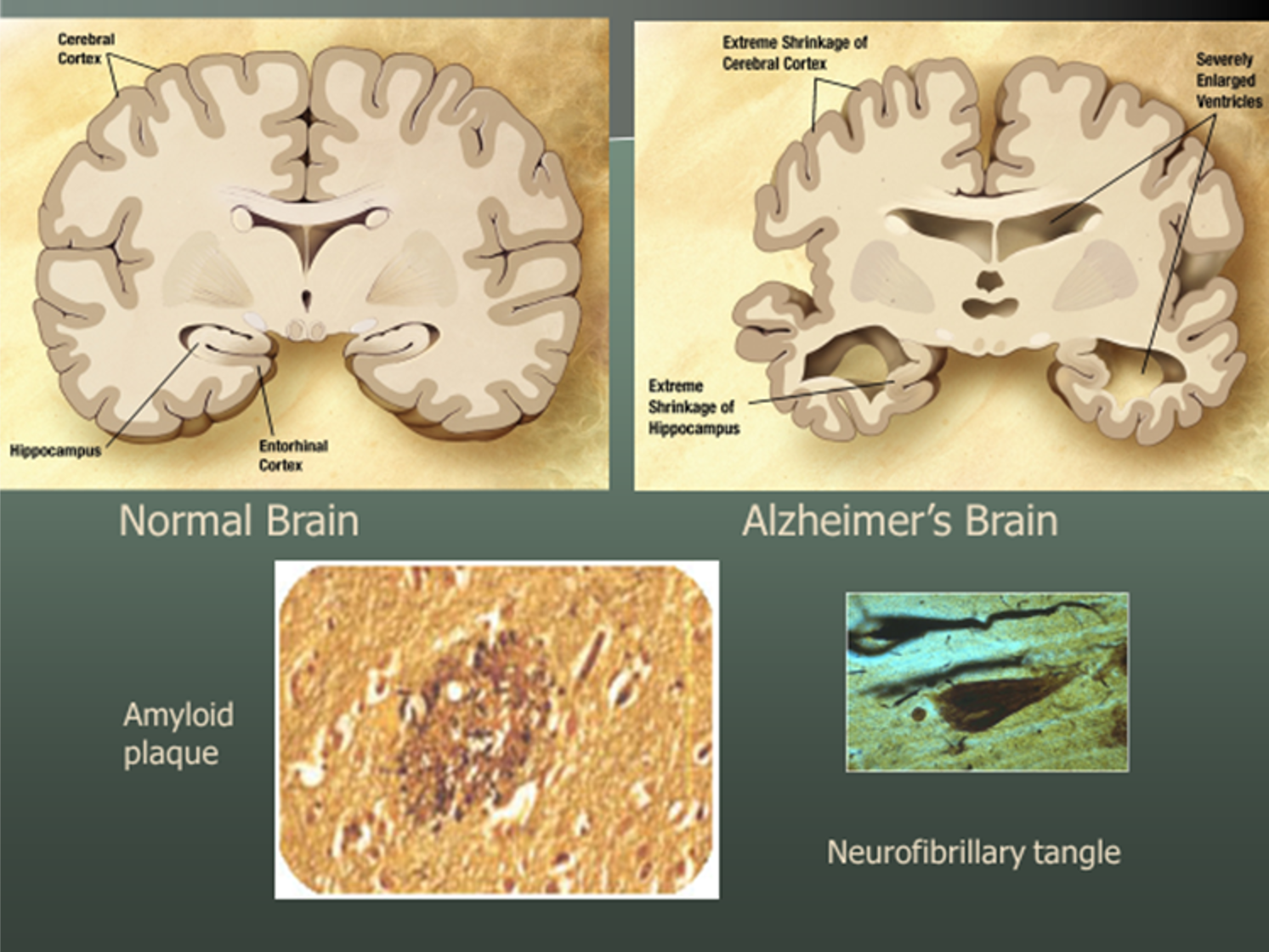 What Is Alzheimer's Disease?